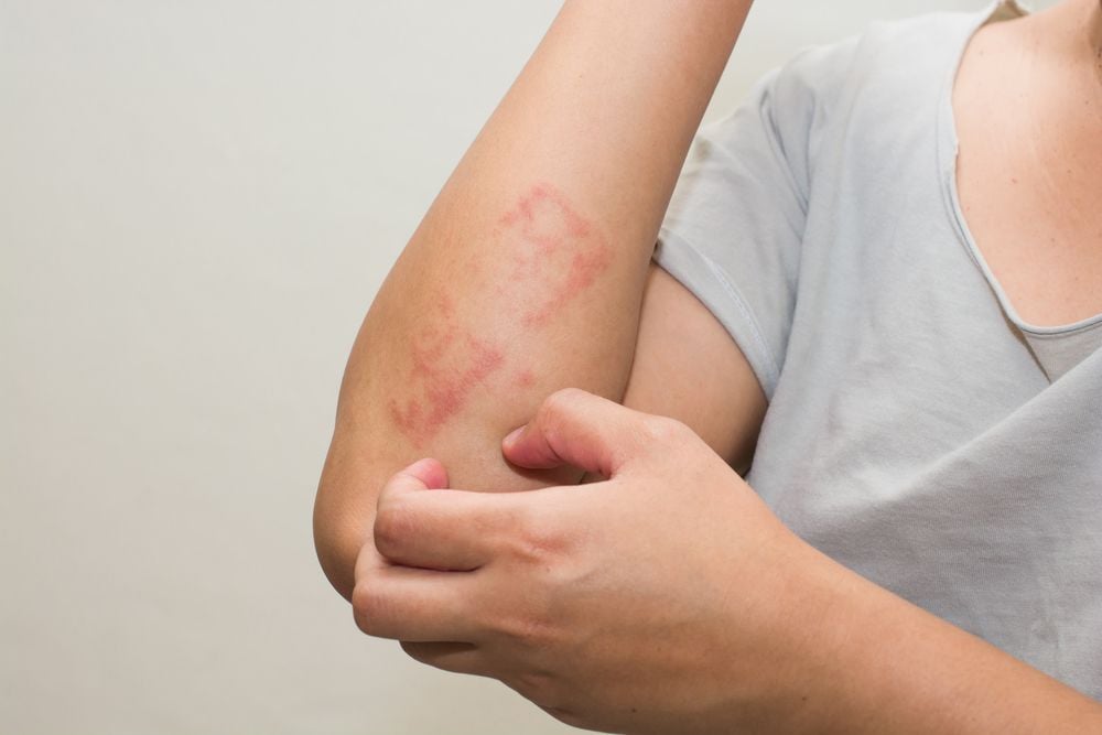 Eczema