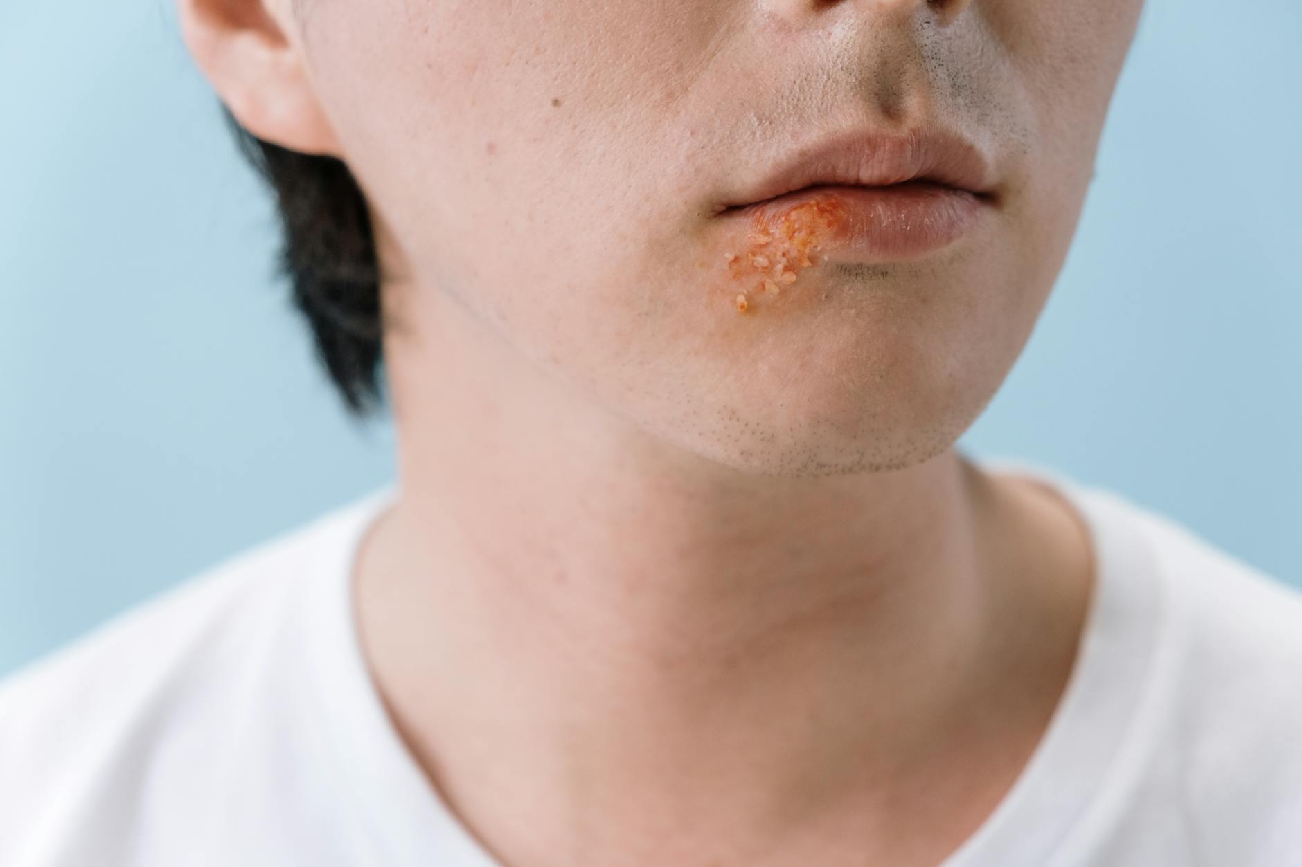 Fungal Infections & Ringworm